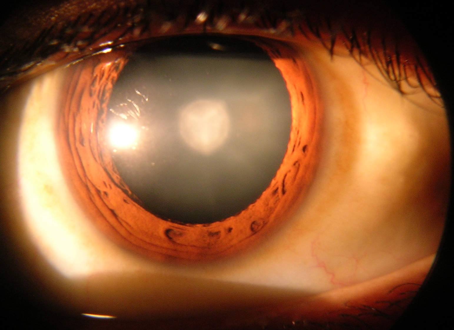 Close-up photograph of a cataract in a human eye