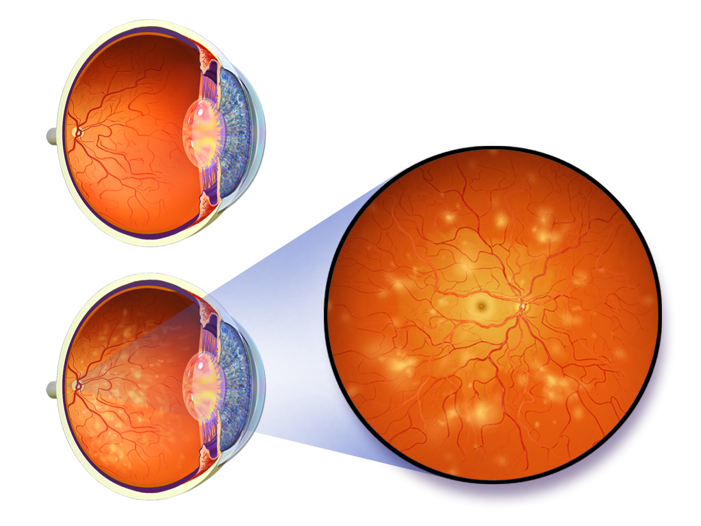 Medical illustration of diabetic retinopathy in the retina