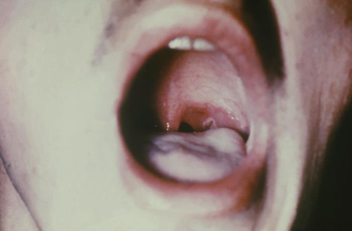 Adherent gray pharyngeal pseudomembrane in diphtheria