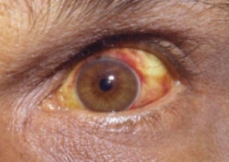 Red conjunctiva caused by conjunctival suffusion in leptospirosis