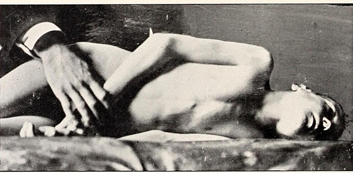 Patient with tetanus showing opisthotonus caused by severe muscle spasm
