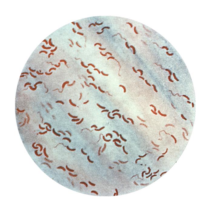 Gram stain showing curved Vibrio cholerae bacilli